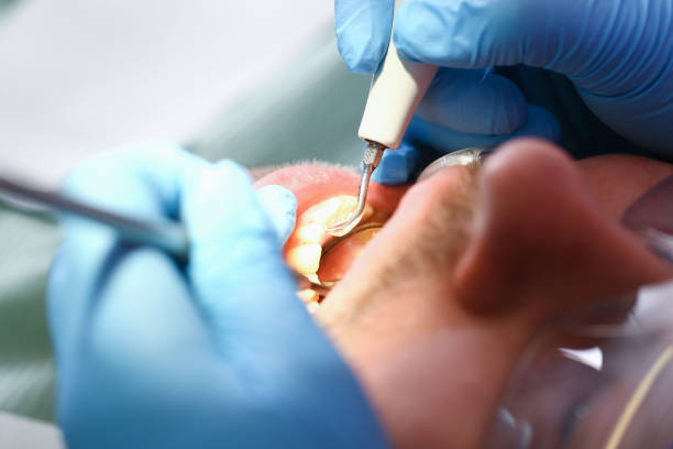 Best Emergency Dental Care for Broken or Chipped Teeth in Upland, IN