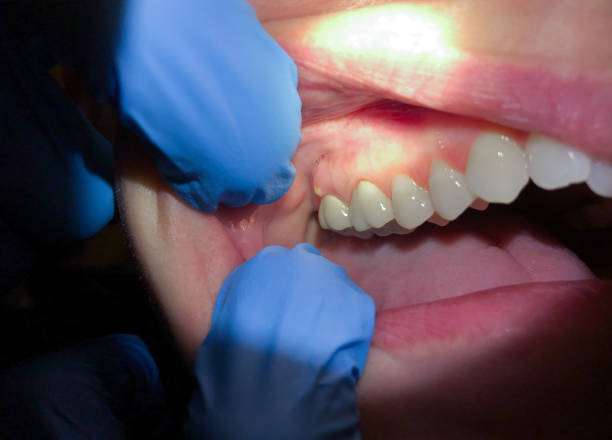 Best Emergency Treatment for Dental Infections or Abscesses in Upland, IN