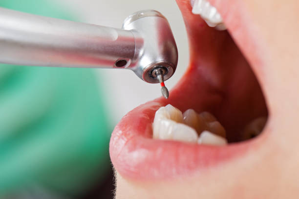 Best Emergency Tooth Extraction in Upland, IN